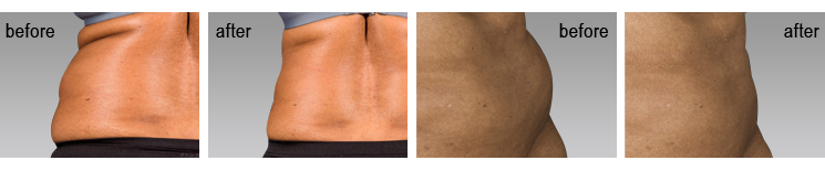before and after sculpsure testimonials miami