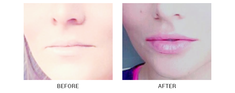 Injectables And Fillers At Elite Health Center