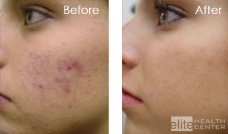 vivace eliminates acne scarring and active acne